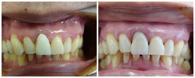 Before and after — Connective Tissue Grafting case by Dr. Yolanda Cruz, Toronto.