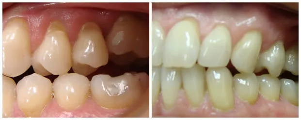 Before and after — Connective Tissue Grafting case by Dr. Yolanda Cruz, Toronto.