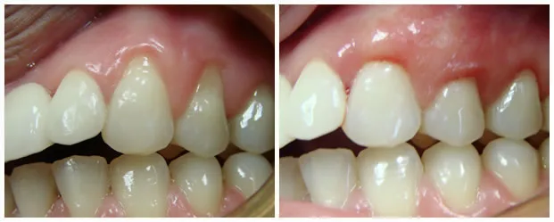 Before and after — Connective Tissue Grafting case by Dr. Yolanda Cruz, Toronto.
