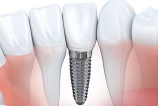dental-implants-featured