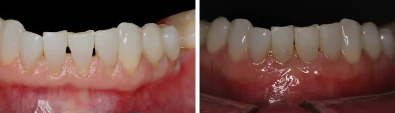 Before and after — Gum Grafting case by Dr. Yolanda Cruz, Toronto.
