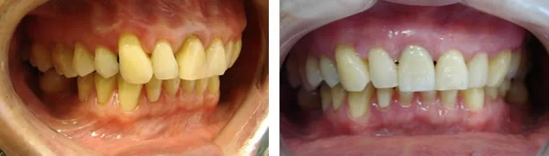Before and after — Gum Grafting case by Dr. Yolanda Cruz, Toronto.