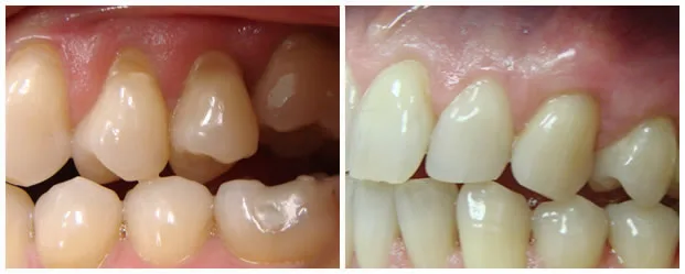 Before and after — Gum Grafting case by Dr. Yolanda Cruz, Toronto.