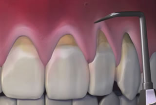 pinhole-surgery-featured