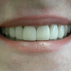 smile-after-a