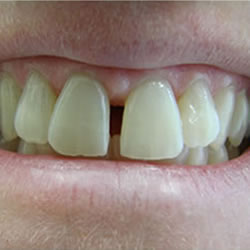 smile-b4-a