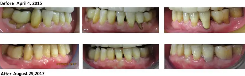 Before and after — Pinhole Surgery case by Dr. Yolanda Cruz, Toronto.