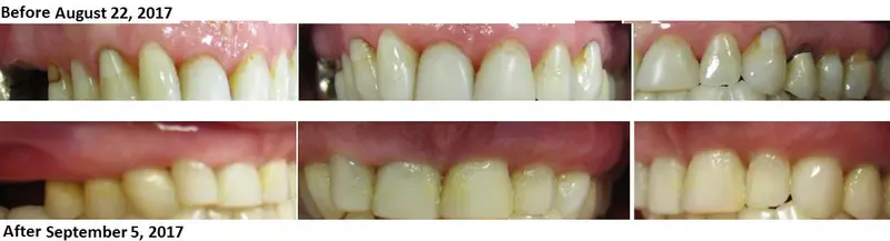 Before and after — Pinhole Surgery case by Dr. Yolanda Cruz, Toronto.
