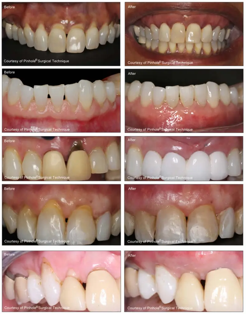 Before and after — Pinhole Surgery case by Dr. Yolanda Cruz, Toronto.