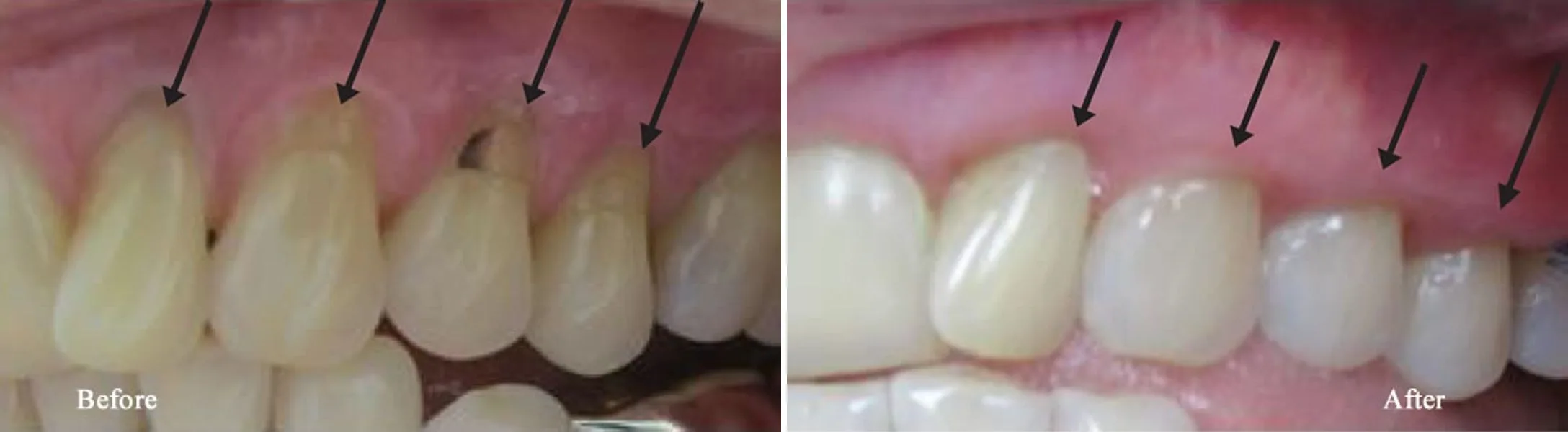 Before and after — Pinhole Surgery case by Dr. Yolanda Cruz, Toronto.