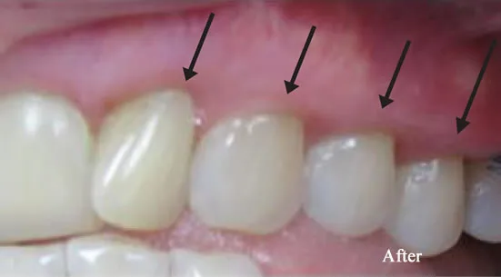 Pinhole Surgery smile gallery