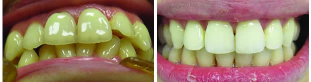 Before and after — Orthodontics case by Dr. Yolanda Cruz, Toronto.