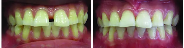 Before and after — Orthodontics case by Dr. Yolanda Cruz, Toronto.