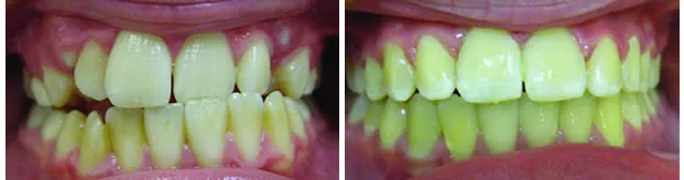Before and after — Orthodontics case by Dr. Yolanda Cruz, Toronto.