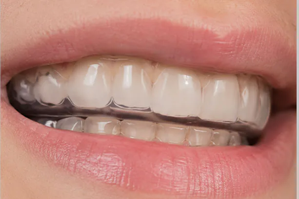 Custom-fitted TMJ stabilization appliance seated over the upper teeth of a patient at Dr. Yolanda Cruz's downtown Toronto practice