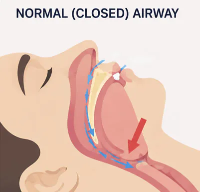 Diagram of a narrow upper jaw and closed nasal airway, illustrating why palate width affects breathing and tongue posture