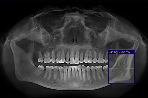 3D CT scan of the jaw showing the condyle and temporomandibular joint anatomy used to evaluate arthritic changes