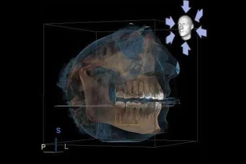 Cone beam CT image of the lower jaw used to evaluate the temporomandibular joint and condylar position before disc recapture treatment