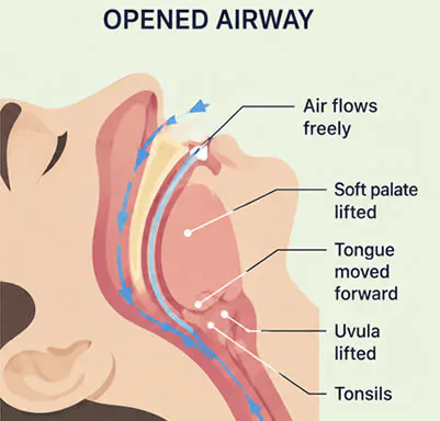 Anatomical diagram showing an open, unobstructed upper airway during normal breathing &mdash; for contrast with the closed airway seen in obstructive sleep apnea