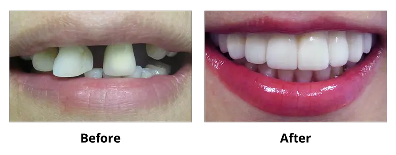 Dental Implants before and after — Dr. Yolanda Cruz Toronto