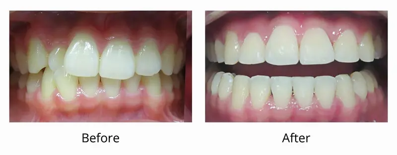 Before and after — Invisalign case by Dr. Yolanda Cruz, Toronto.