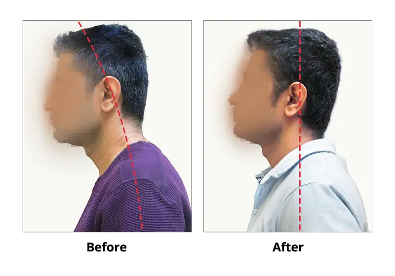 TMJ Before and After Case 1 — head forward posture corrected with TMJ treatment, Dr. Yolanda Cruz Toronto