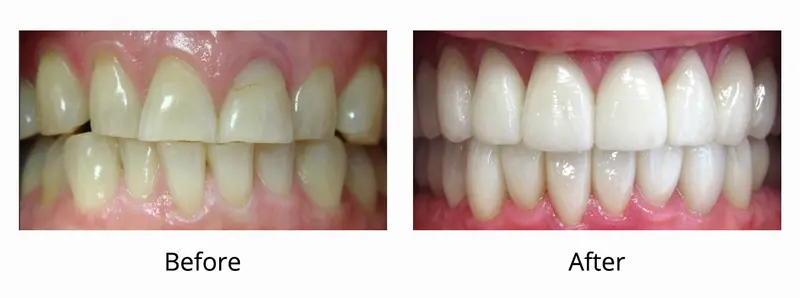 Porcelain Veneers before and after — Dr. Yolanda Cruz Toronto