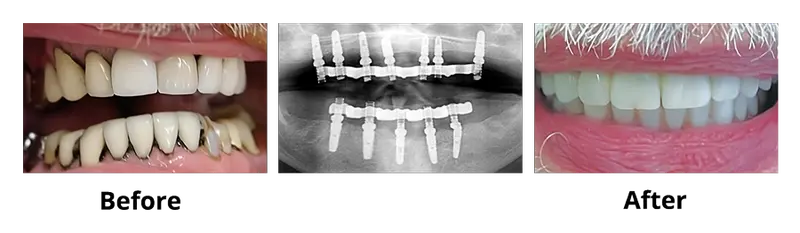 Before and after — Dental Implants case by Dr. Yolanda Cruz, Toronto.