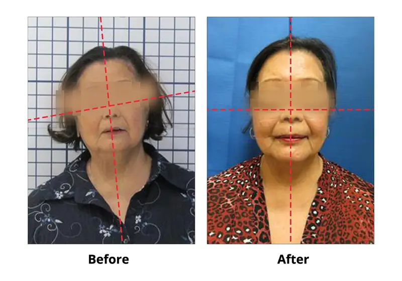 TMJ Before and After Case 2 — asymmetrical face corrected with TMJ treatment, Dr. Yolanda Cruz Toronto