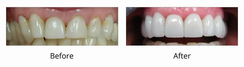 Before and after — Veneers / Lumineers case by Dr. Yolanda Cruz, Toronto.