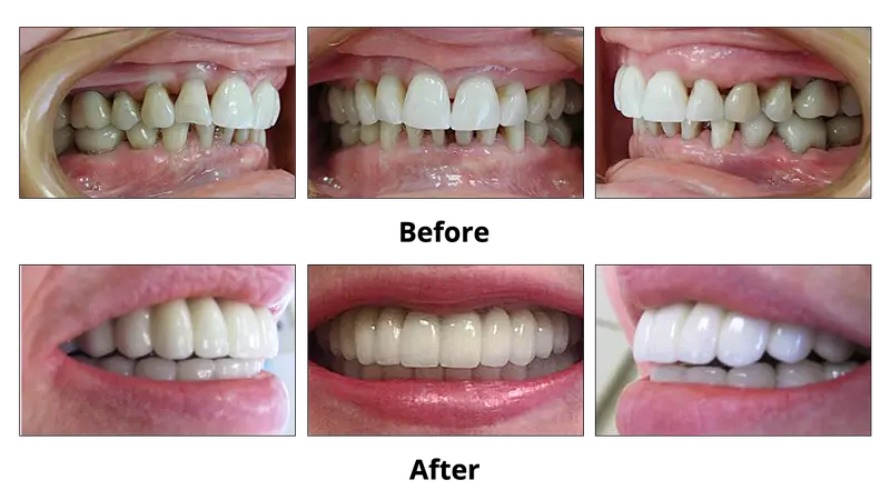 Before and after — Dental Implants case by Dr. Yolanda Cruz, Toronto.