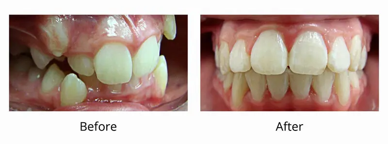 Before and after — Invisalign case by Dr. Yolanda Cruz, Toronto.