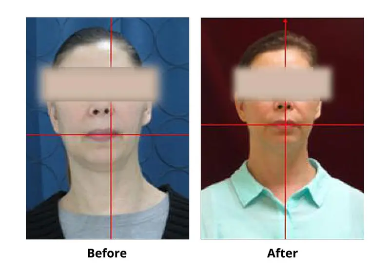 TMJ Before and After Case 3 — headache and migraine relief with TMJ treatment, Dr. Yolanda Cruz Toronto