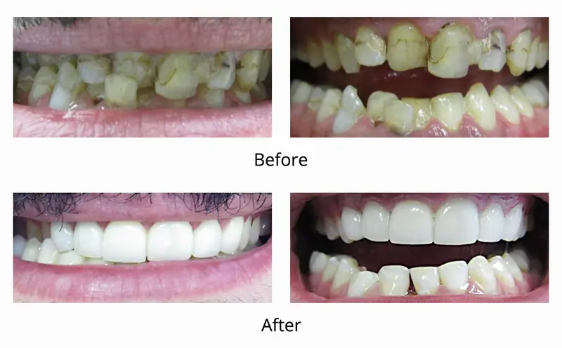 Before and after — Veneers / Lumineers case by Dr. Yolanda Cruz, Toronto.