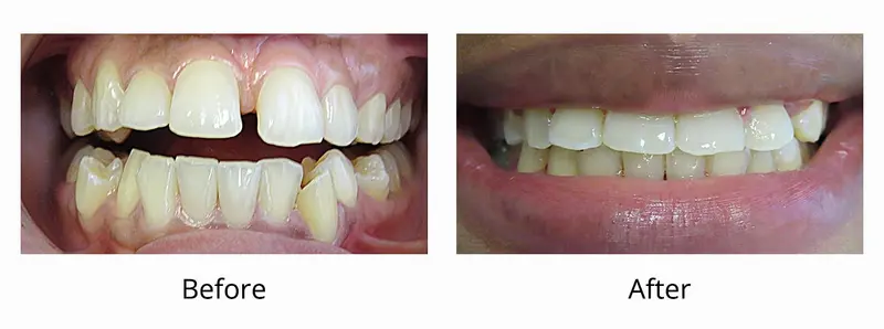 Before and after — Invisalign case by Dr. Yolanda Cruz, Toronto.
