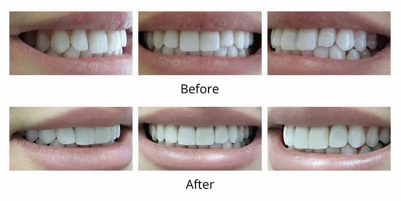 Before and after — Veneers / Lumineers case by Dr. Yolanda Cruz, Toronto.
