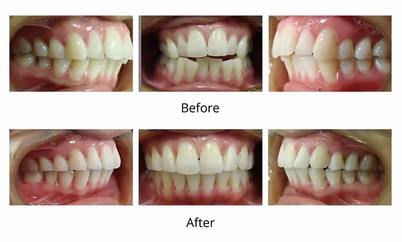 Before and after — Invisalign case by Dr. Yolanda Cruz, Toronto.