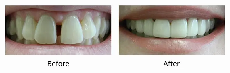 Before and after — Veneers / Lumineers case by Dr. Yolanda Cruz, Toronto.