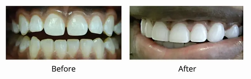Before and after — Veneers / Lumineers case by Dr. Yolanda Cruz, Toronto.