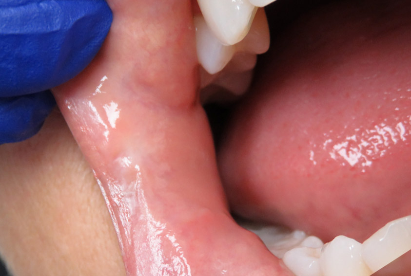 Healed area after Fotona laser mucocele removal — smooth tissue with no scarring