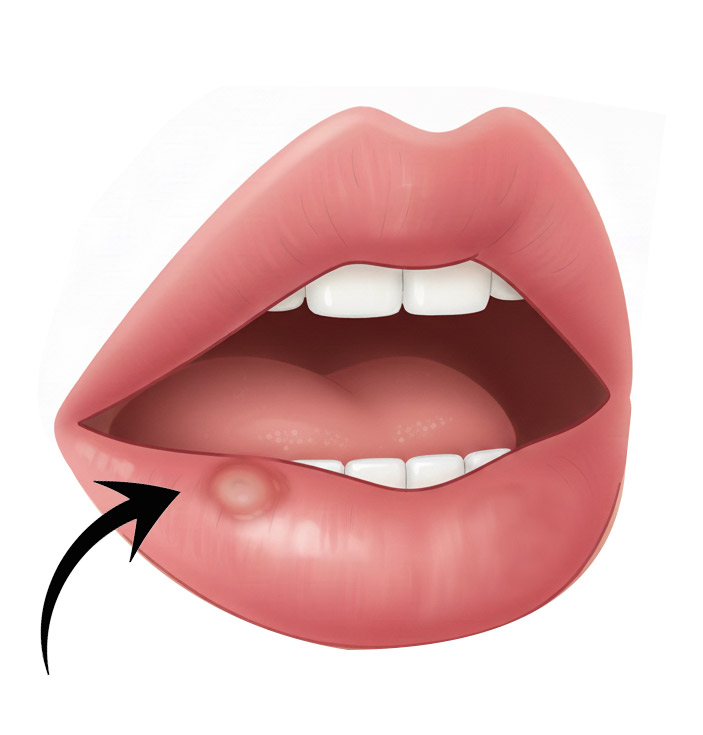 Illustration of a mucocele — a small fluid-filled bump on the inside of the lip