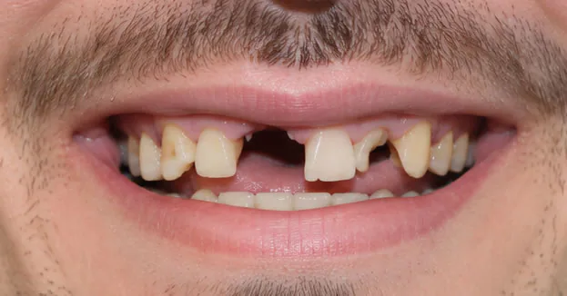 Before full mouth restoration — damaged and missing teeth