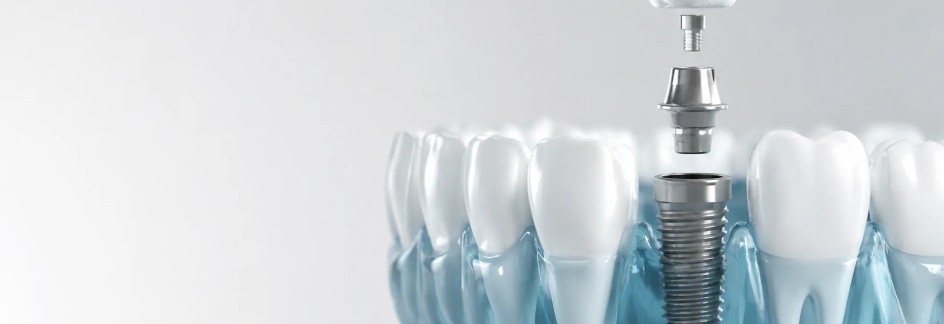 Computer guided dental implants at Dentistry On The PATH
