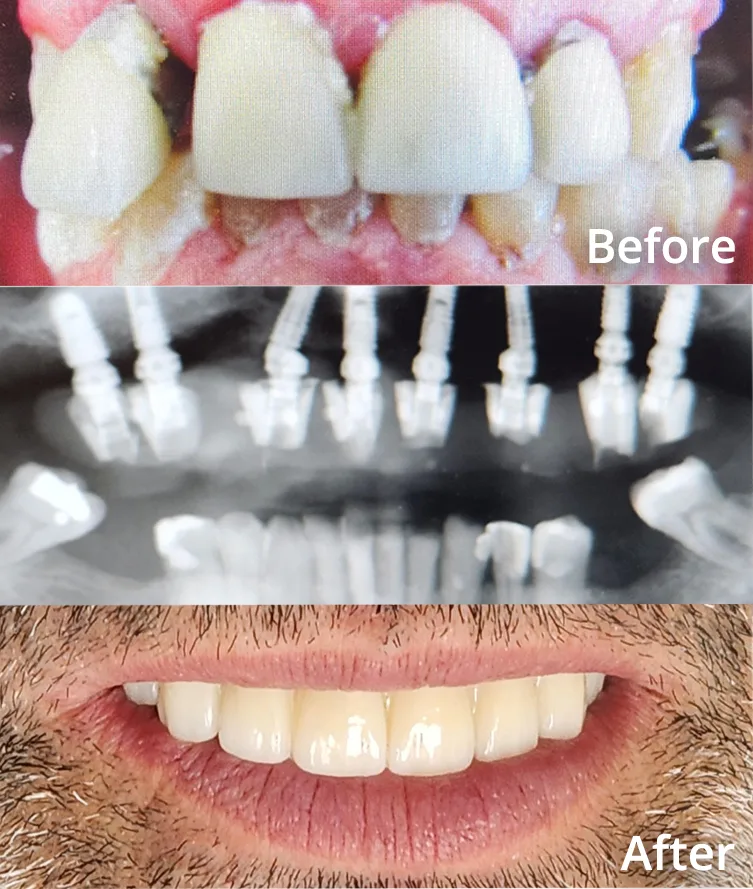 Before and after full-arch dental implant case showing badly worn and decayed teeth replaced with an implant-supported restoration, with X-ray of the placed implants