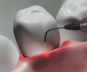 Laser Gum Treatment in Toronto, ON