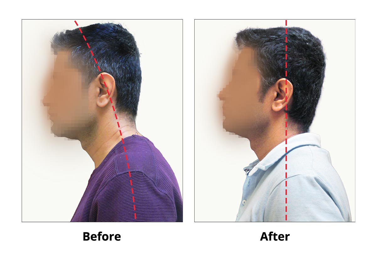 TMD TMJ Before After Case Head forward posture