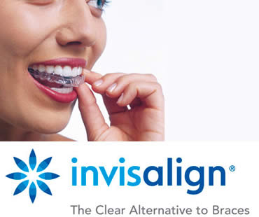 The Invisalign Process